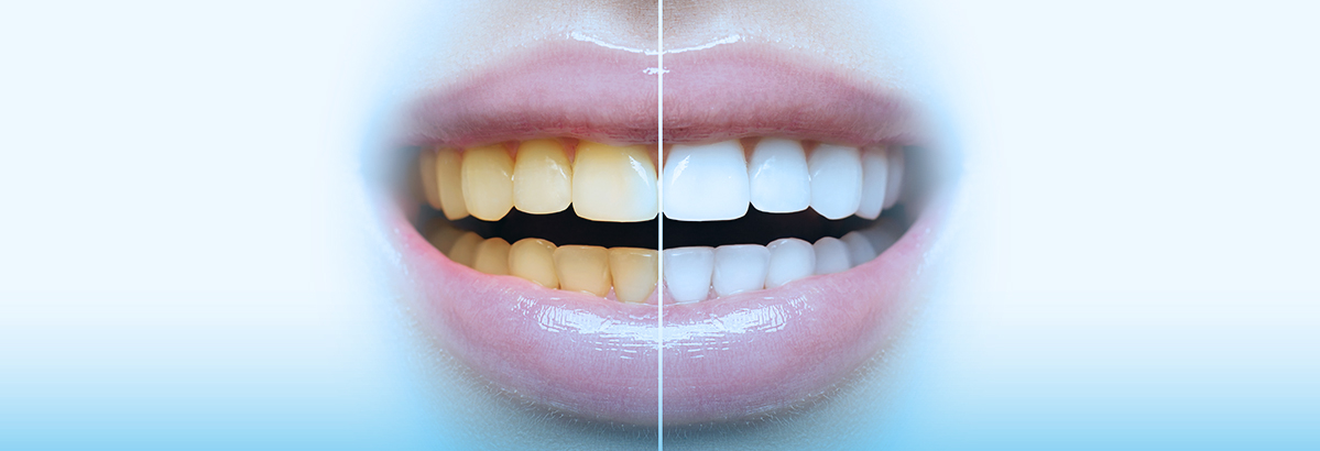 Como evitar dentes amarelados? Descubra em 5 dicas!