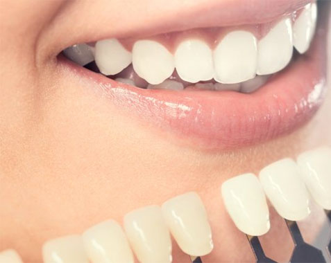 finas próteses de porcelana que irão promover um sorriso harmônico e natural.