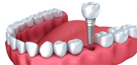 Limpeza e remoção de placa bacteriana e tártaro dentário