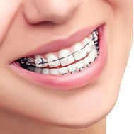 asthetic alginer esthetic alginer