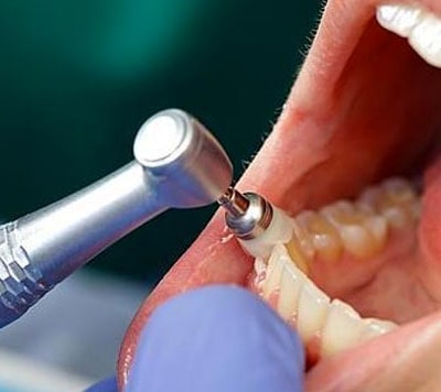 Limpeza e remoção de placa bacteriana e tártaro dentário